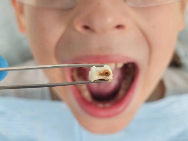 Best Emergency Dentist for Knocked-Out Tooth in Winton, CA